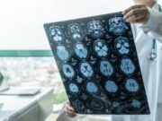 ASTUCE Spain defensa més recerca sobre l’oligodendroglioma